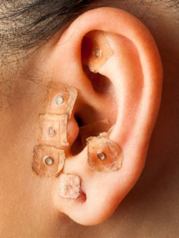 auriculoterapia